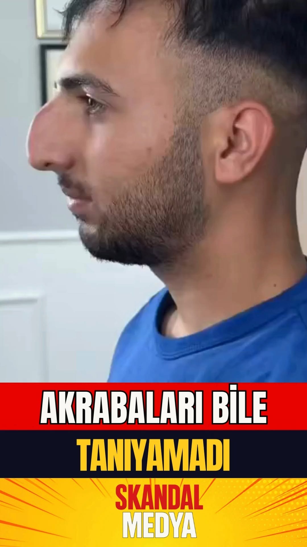 Burun Estetiği: Yeniden Doğuş - Hayatımın En Doğru Kararı