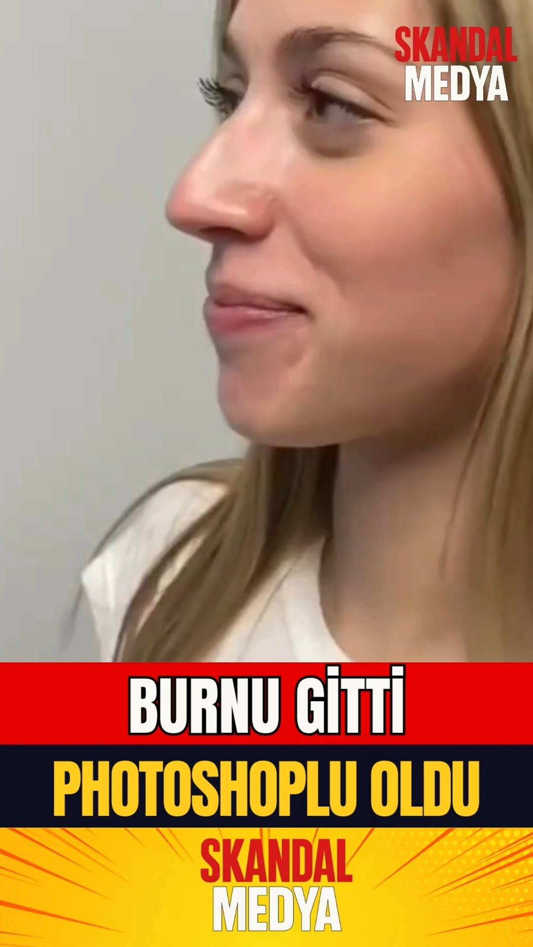 Burun Estetiği ile Bambaşka Bir Haya Bürünen Kadın!