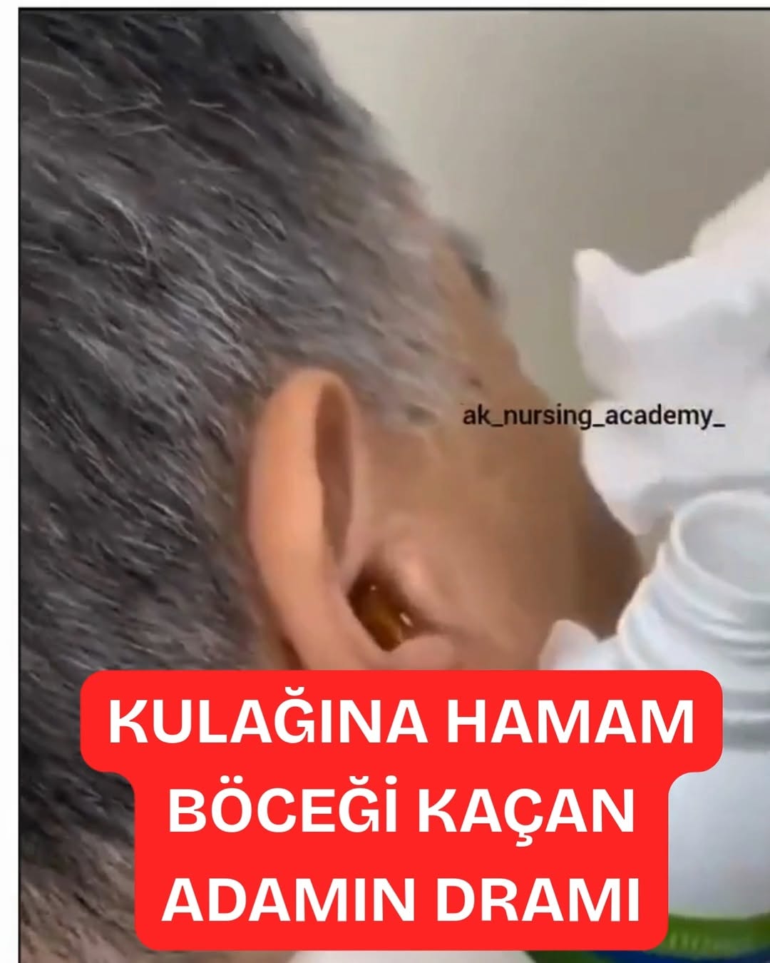 Hamam Böceği Kaçan Adamın Dramı: Kulağına Yuva Yapan Koca Böcek