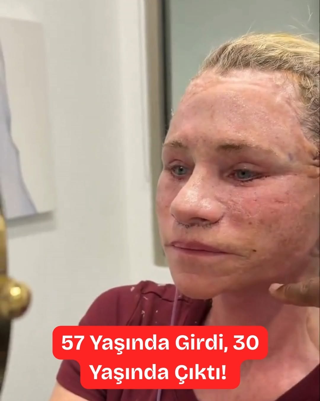 57 Yaşında Girdi, 30 Yaşında Çıktı! Yüz Gerdirme Ve Gençleştirme Operasyonu
