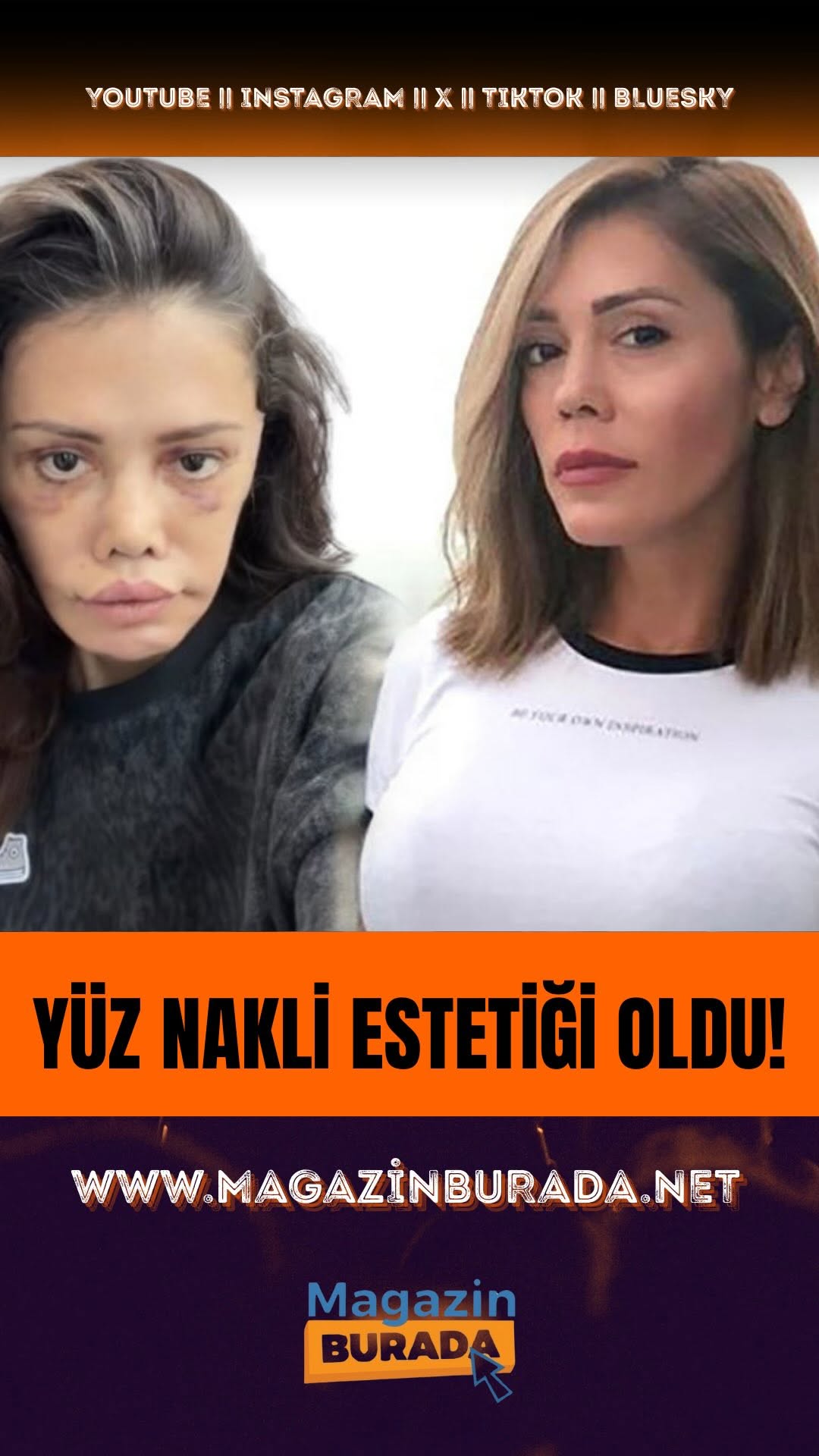 Didem Ceran, Estetik Amaclı Yüz Nakli Operasyonu Gerçirdi